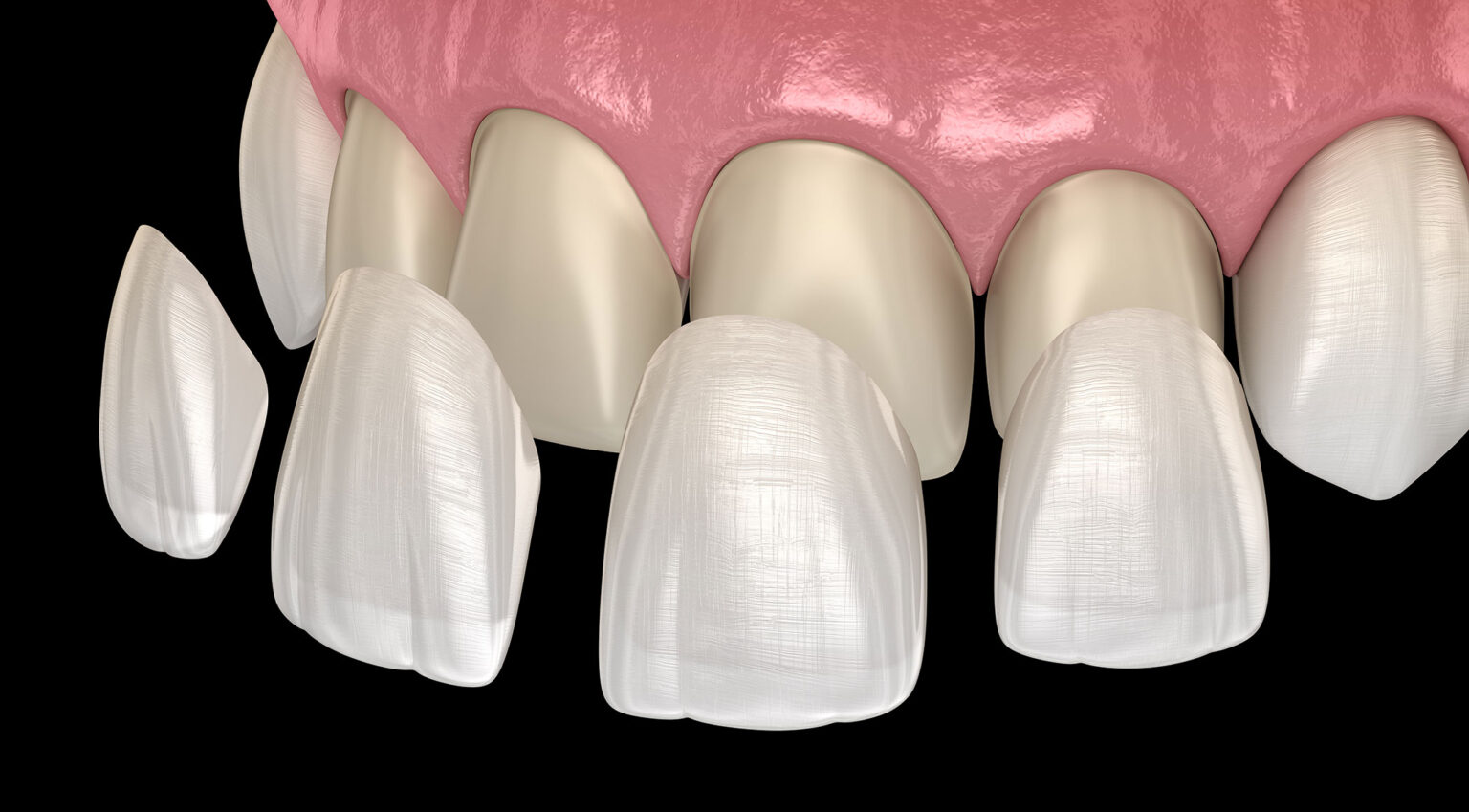 Porcelain Veneers - Smile Center Villa Rica