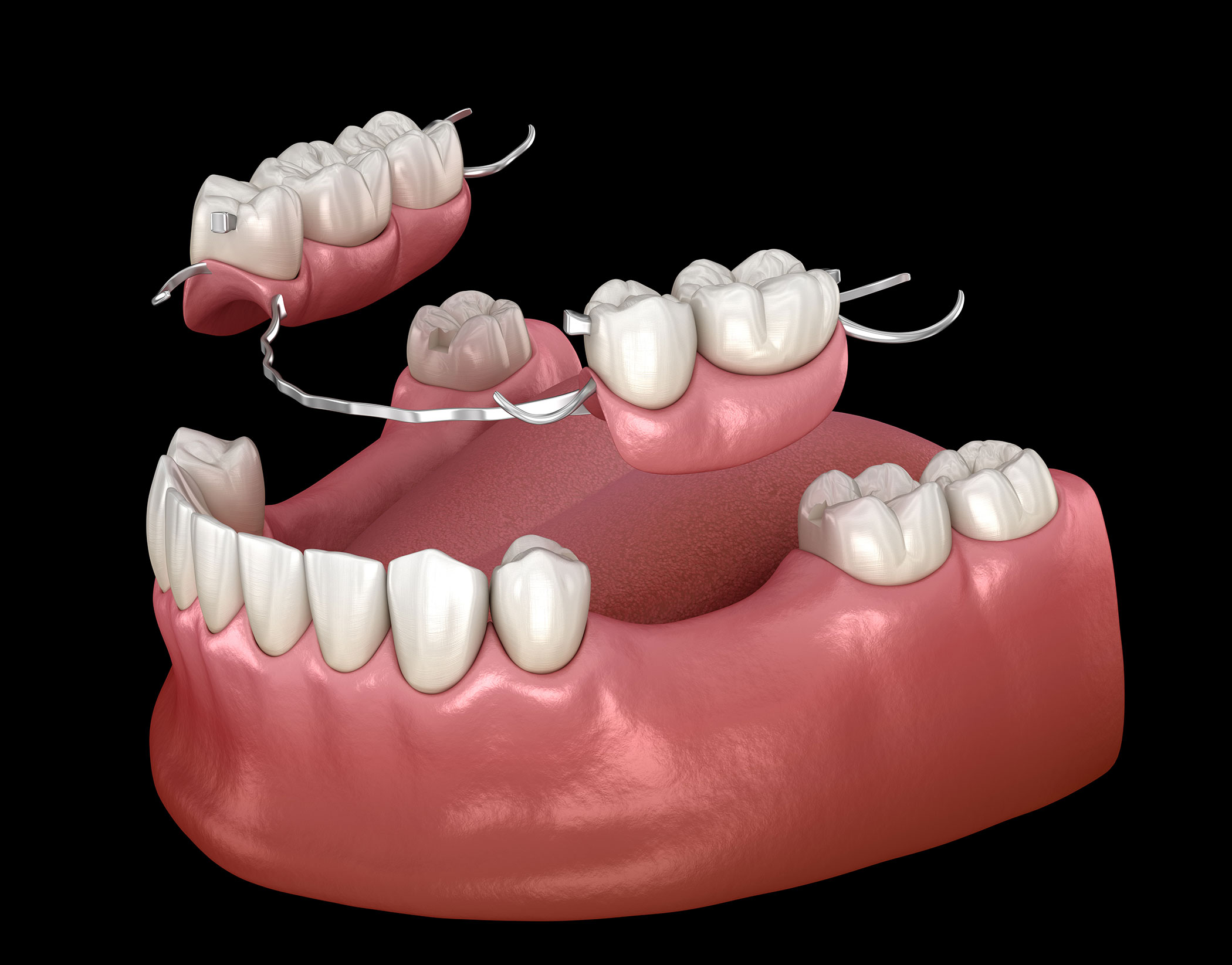 Full & Partial Dentures by Atlanta Dentures in Marietta, GA