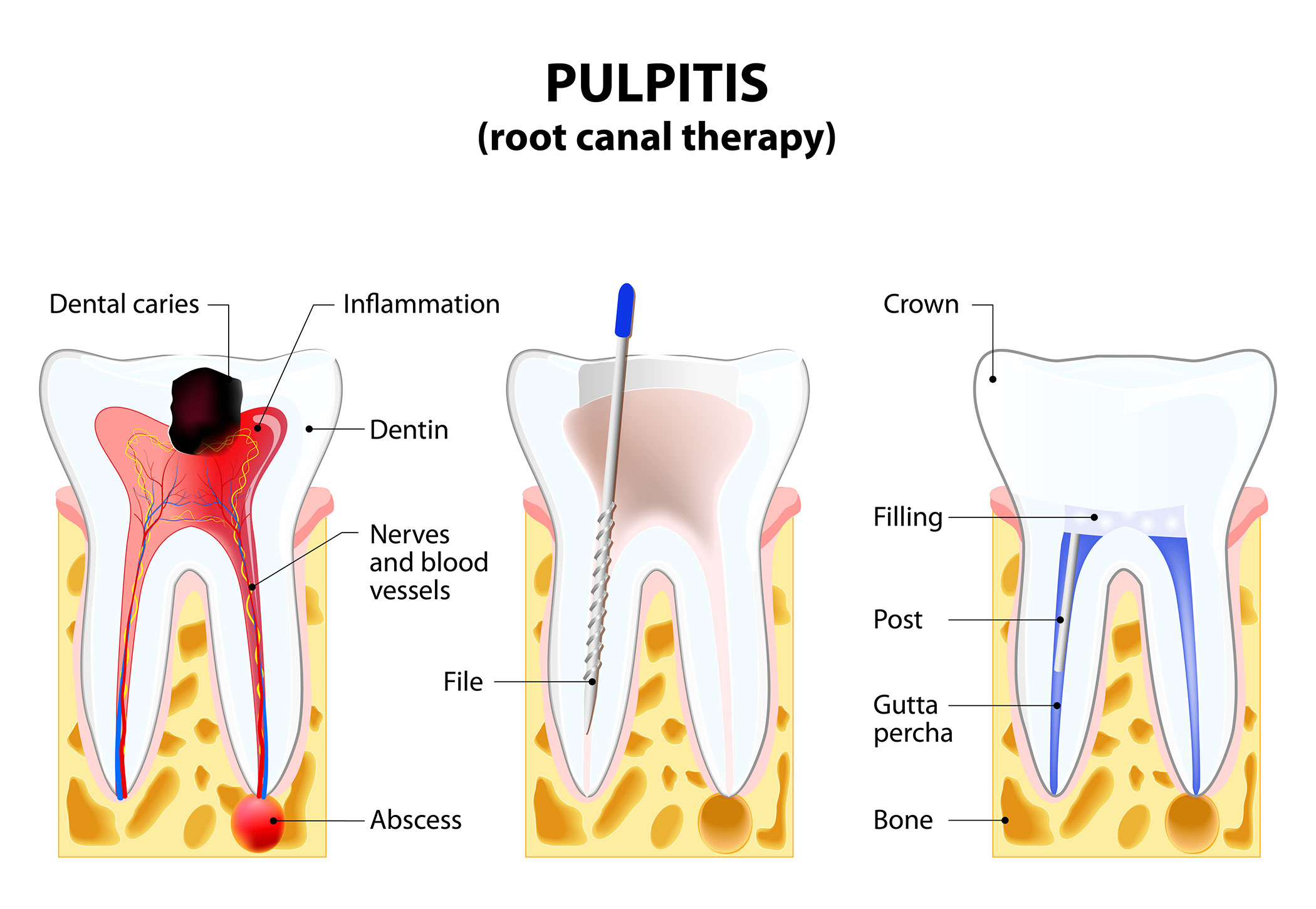 root-canal-therapy-smile-center-villa-rica